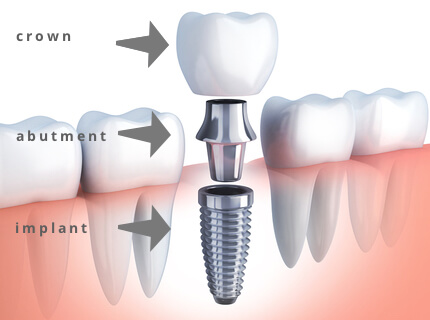 Dental implant components